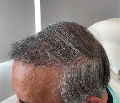 precision medical hair restoration|Precision Medical Hair .